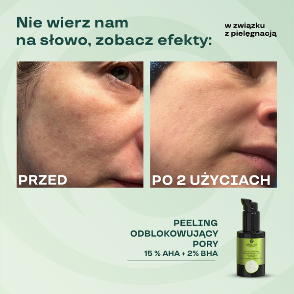 BasicLab Peeling Kwasowy 15 AHA 2 BHA - Profesjonalne Oczyszczanie Porów i Odnowa Skóry 30 ml