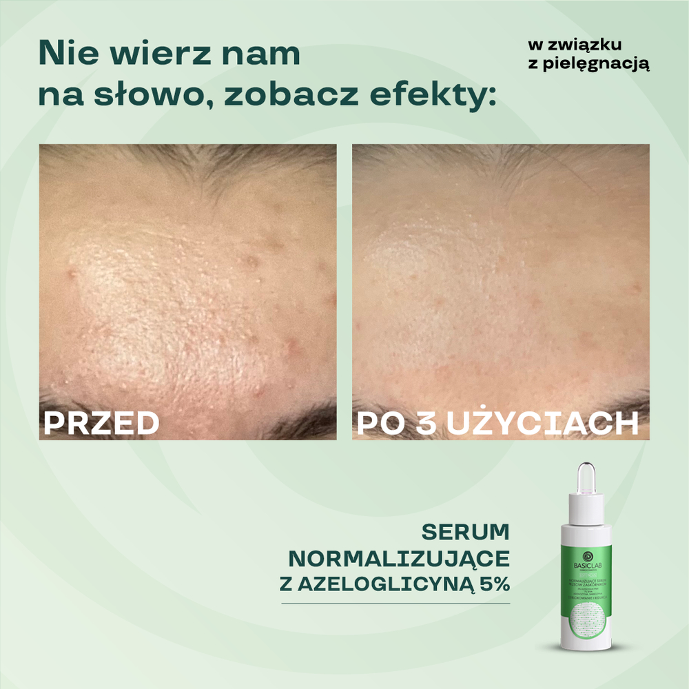 BasicLab Advanced Anti-Blackhead Serum with 5% Azeloglycine & 1% BHA for Clear, Balanced Skin - 30ml