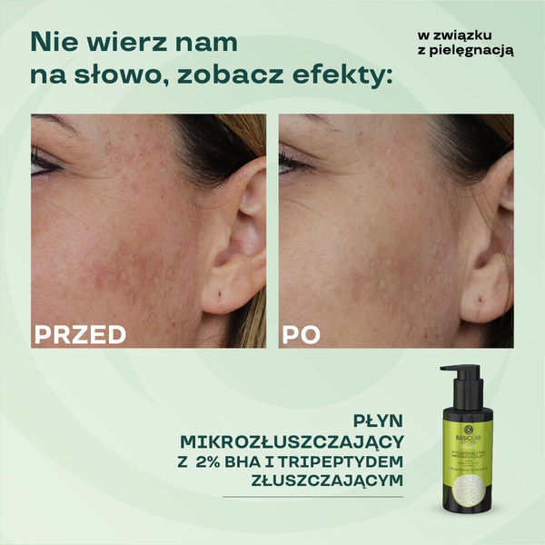 BasicLab Zaawansowany Płyn Mikrozłuszczający z 2%BHA dla Skóry Trądzikowej - 100 ml